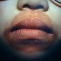 candidiasisperioral.jpg