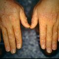 cementdermatitis9-609.jpg