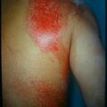cementdermatitis9-721.jpg