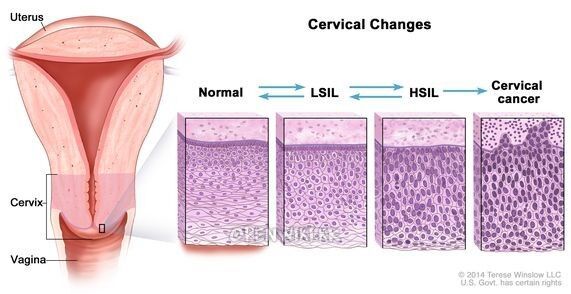 cerivaldysplasia.jpg