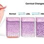 cerivaldysplasia.jpg