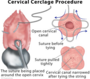 med:cervical_cerclage-203955.png