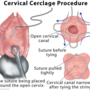 cervical_cerclage-203955.png