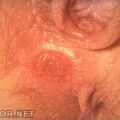 chancre_syphilitique4.jpg