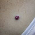 cherry-angioma-pictures.jpg