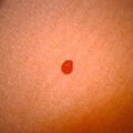 cherryangioma9-302.jpg