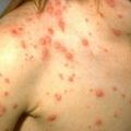 chickenpox.jpg