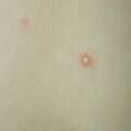 chickenpox020514-2.jpg