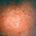 chickenpox5-28.jpg