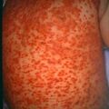 chickenpox5-29.jpg