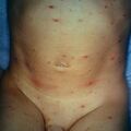 chickpox9-553.jpg
