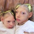 children-born-with-microcephaly.jpg