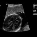 choroid_plexus_cyst_02.jpg