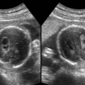 choroid_plexus_cyst_0221114715.png