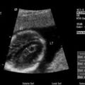 choroid_plexus_cyst_04.jpg
