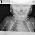 clavicle_fracture.jpg