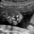 cleftlip01.jpg