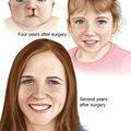 cleftlip05.jpg
