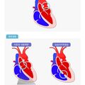 coarctation_of_the_aorta.jpg