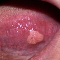condyloma005.jpg