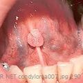 condyloma007.jpg