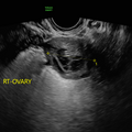 corpus_luteum_4532.png