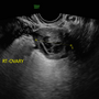 corpus_luteum_4532.png