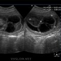 cystic-hygroma-2a.jpg