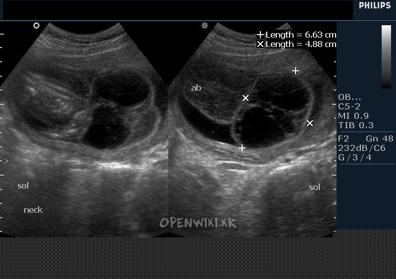 cystic-hygroma-2a.jpg