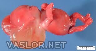 cystic_hygroma.jpg