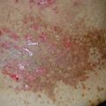 dariersdisease020108-3.jpg