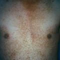 dariersdisease5-246.jpg