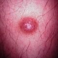 dermatofibroma2000-243.jpg