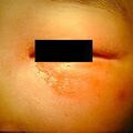 dermatomyositis3-644.jpg