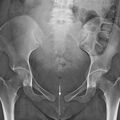 diastasis_symphysis_pubis.jpg