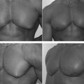 drug_gynecomastia.jpg