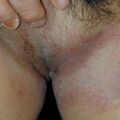 eczema_groin020108.jpg