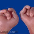 edwards-syndrome-5.jpg