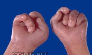 에드워드 증후군에 나타나는 손의 특징적인 모양  