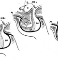 empty_sella_syndrome_02.png