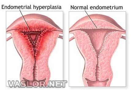 endometrial_hyperplasia.jpg