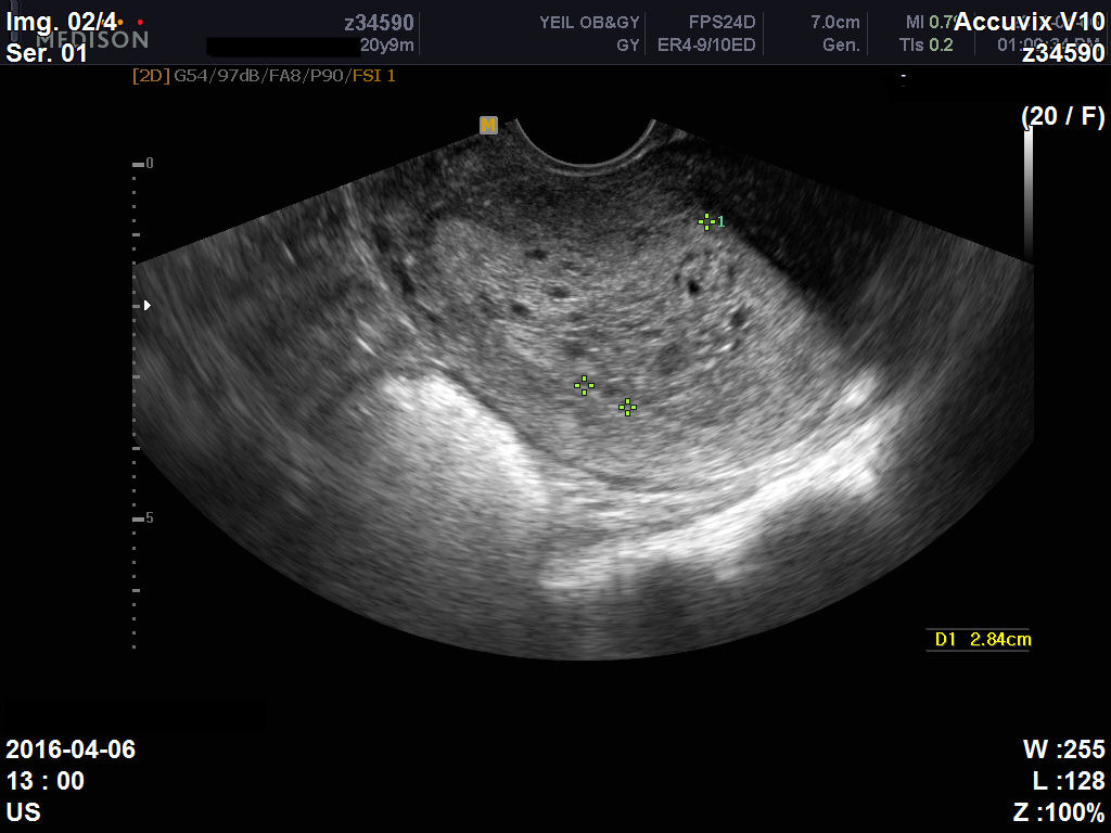 Complex Endometrial hyperplasia with atypia