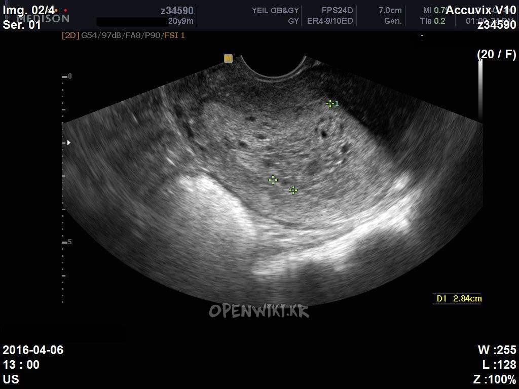 endometrial_hyperplasia_complex_atypia.jpg