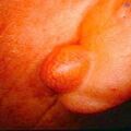 epidermalcyst_ear.jpg