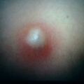 epidermalcyst_inf.jpg