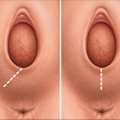 episiotomy_0209171244v_l.png