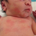 erythema_toxicum_neonatorum-122426.png