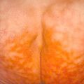 erythemaabigne9-244.jpg