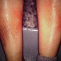 erythemanodosum9-1054.jpg