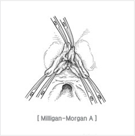 excision_and_ligation01.jpg